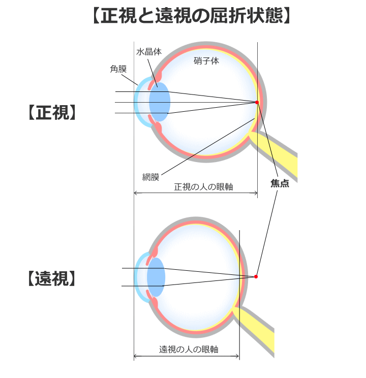 遠視と正視の屈折状態