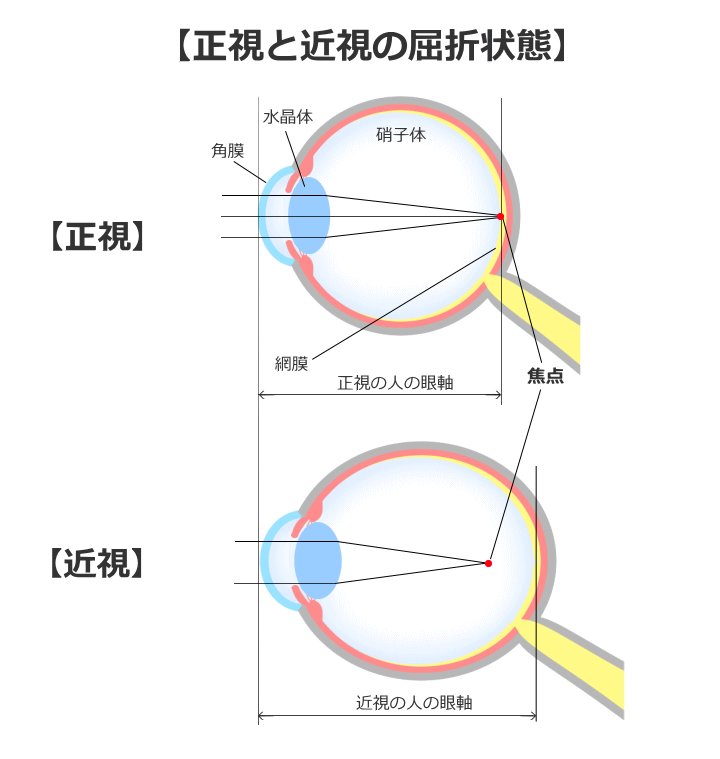 正視と強度近視の眼軸の長さ