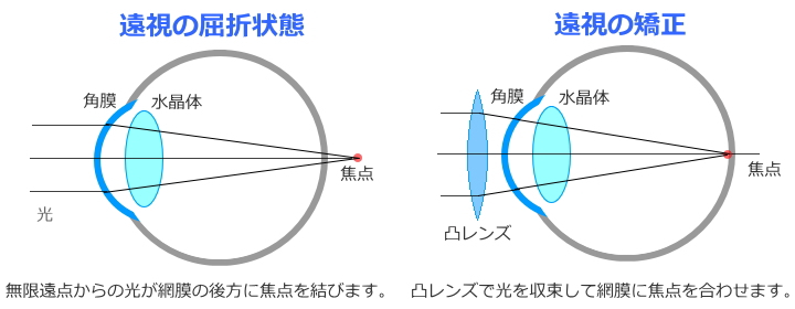 遠視とその矯正