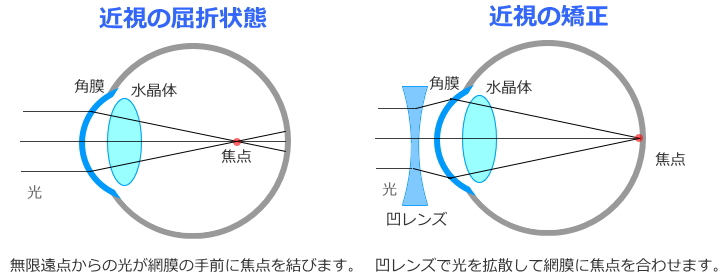 近視とその矯正