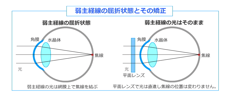 乱視-弱主経線屈折状態と矯正