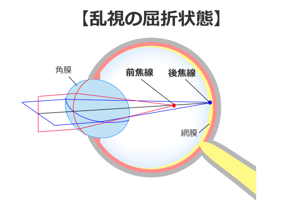 乱視の屈折状態