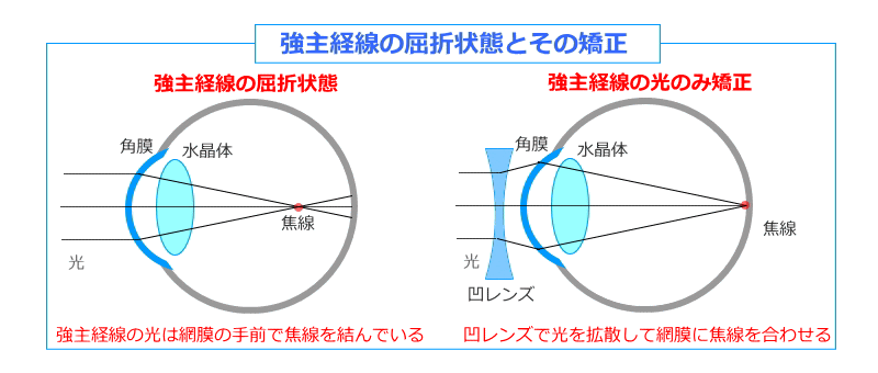 乱視-強主経線の屈折状態と矯正