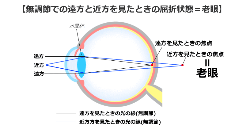 老眼の屈折状況